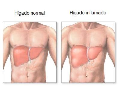 img_cuales_son_los_sintomas_del_higado_inflamado_24106_orig