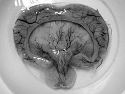 holoprosencephaly