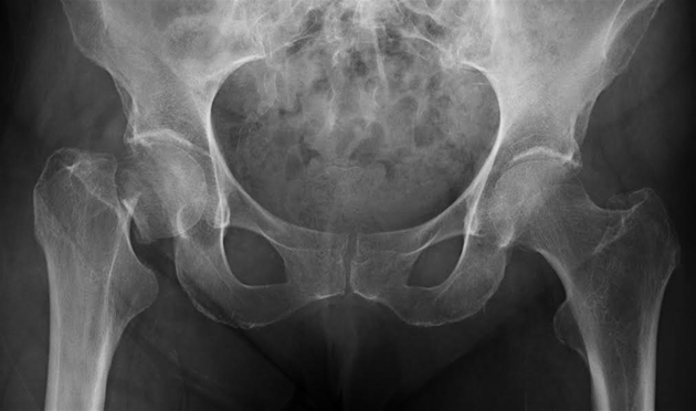 padecer-osteoporosis-huesos-630