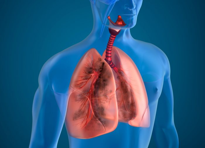 cáncer-de-pulmón-700x508