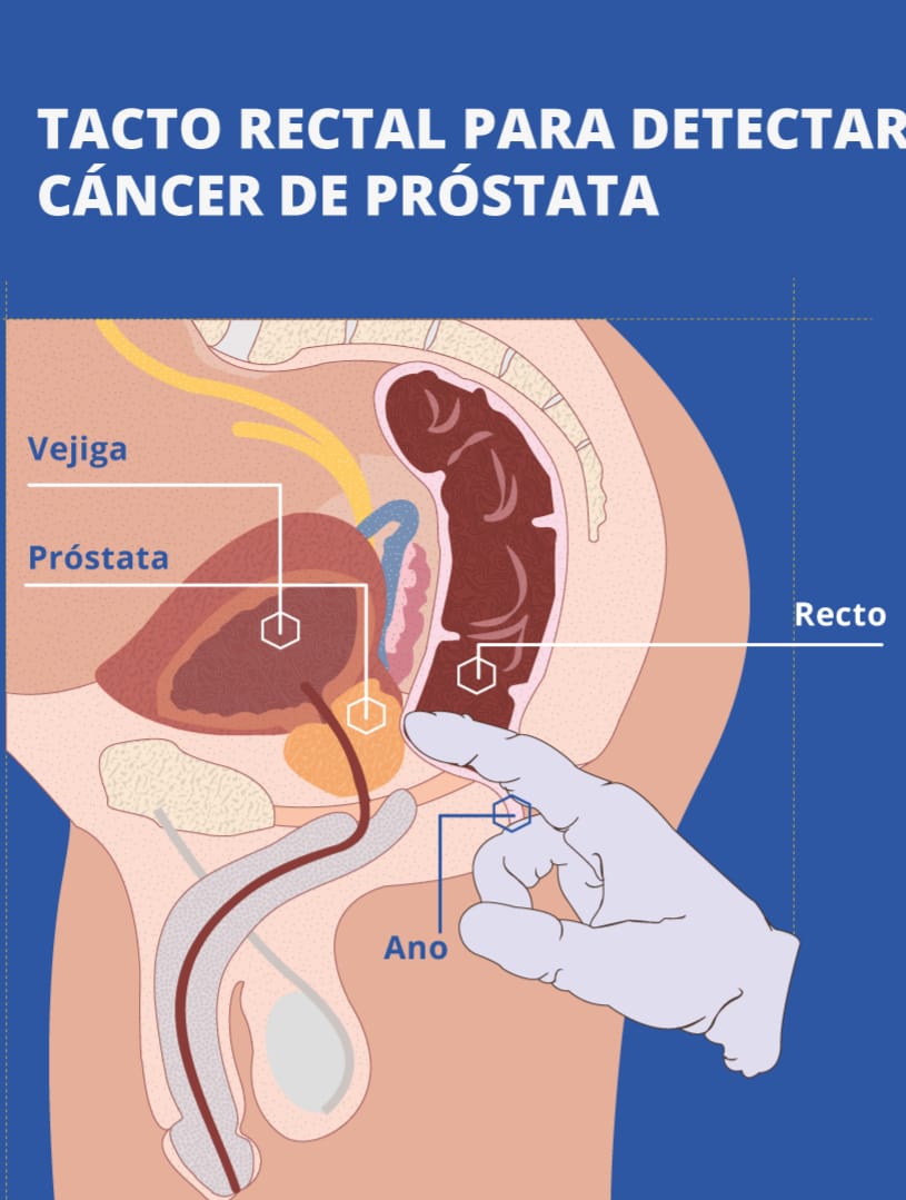 La Respuesta al Cáncer de Próstata es la Prevención