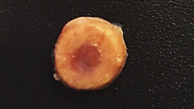 medula-osea