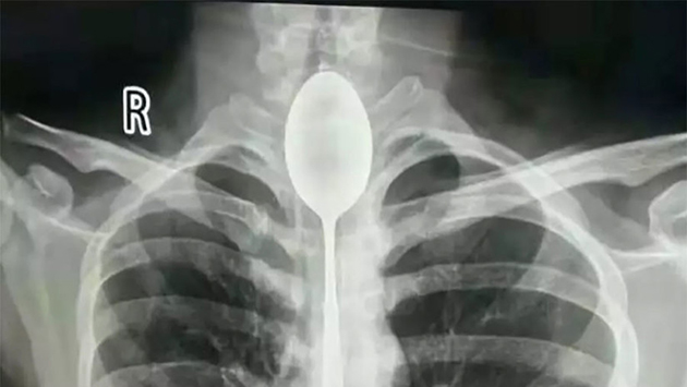 cuchara-metal-esofago-chino-630